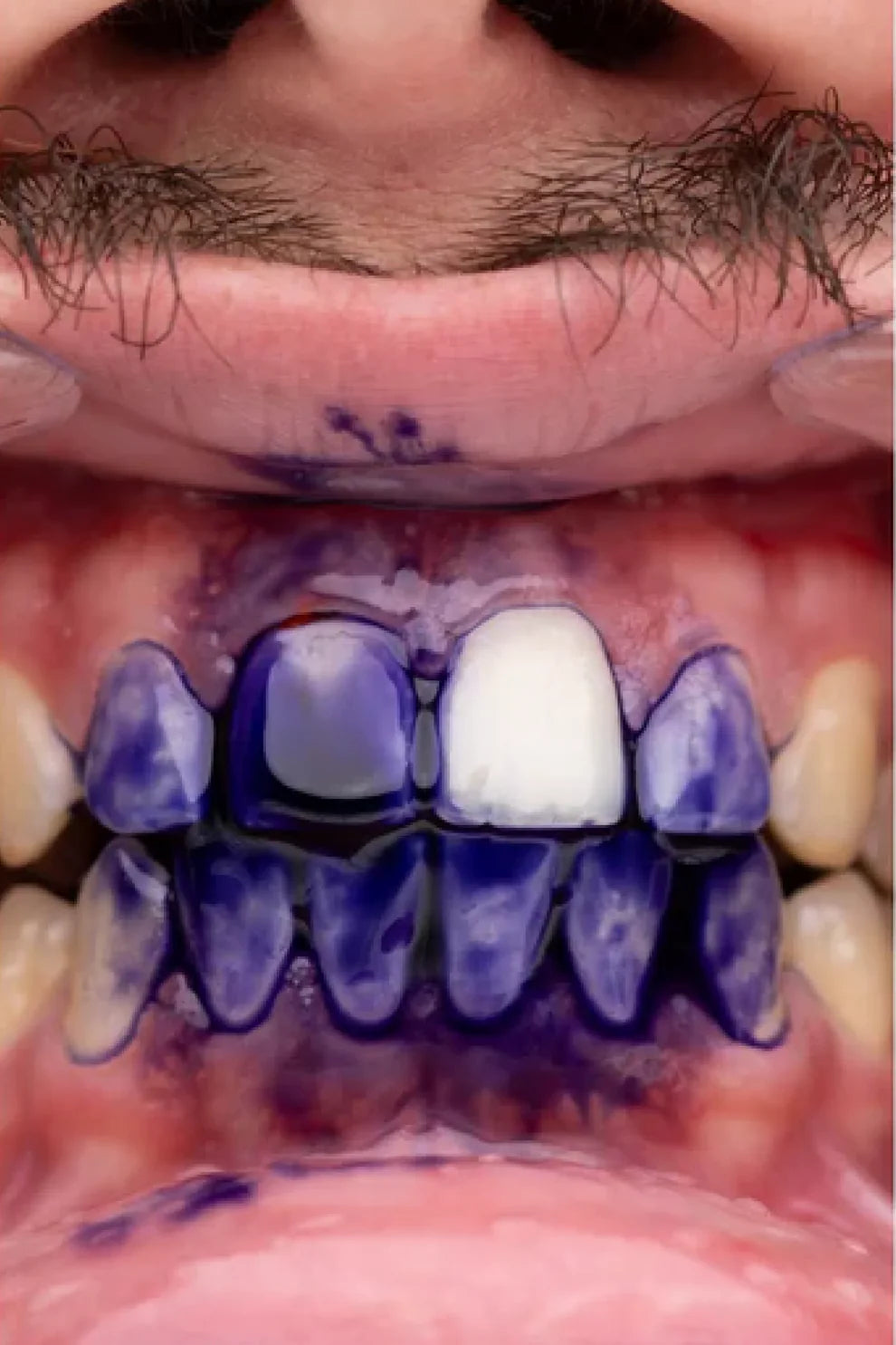OBSESSIVE™ -  Gel blanqueador dental